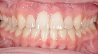 After Treatment
