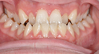 Before Treatment